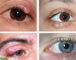They'll recur without surgical excision. Get Rid Of The Lumps In The Eyelid Visihow