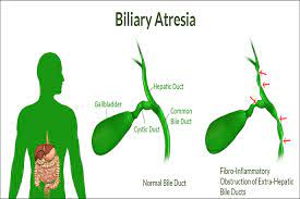 Bile is a liquid which passes into the gut through small tubes called bile ducts and is stored in the gall bladder. Biliary Atresia Treatment In Ayurveda With Herbal Remedies