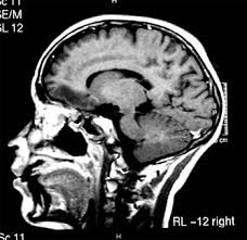 Pía spalloni m, patricia glaser k, patricia verdugo l. Rhinocerebral Mucormycosis Healing In A Pediatric Patient With Active Leukemia