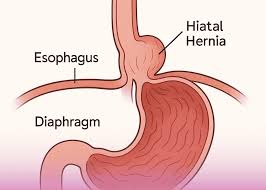 Image result for stomach hernia symptoms