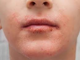 Dry Skin Around The Mouth Causes And Remedies Dry Skin On Face Healing Dry Skin Facial For Dry Skin