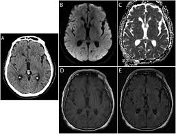 Image result for Cryptococcal Meningitis