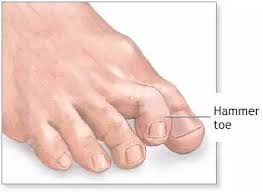 Image result for Hammer toe