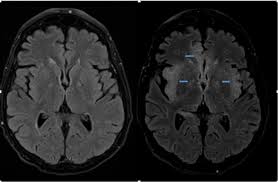 Image result for HSV Encephalitis