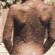 Monkeypox virus is an orthopoxvirus that causes a disease with symptoms similar, but less severe, to smallpox. Monkeypox Virus Causes Monkeypox Santripty Occurs Central West Africa
