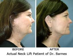 Turkey neck—as it's charmingly called—is what happens when the skin underneath your chin becomes loose and lax, resembling (you guessed it) a as they get older and the angle of their chin becomes more obtuse, the condition becomes more pronounced.if having a turkey neck runs in your. Wave Goodbye To Turkey Neck With Laser Lipo Ahb