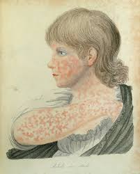 Perspectives Case histories Rubella