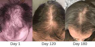 Kiierr Laser Hair Growth Cap 2021 S Best Laser Cap For Hair Loss