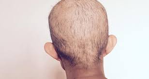 For the most part, thankfully, chemotherapy does not cause permanent hair loss. Effects Of Chemotherapy On Hair Skin And Nails Good To Know