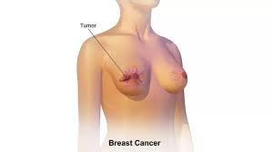 Image result for Breast Cancer