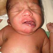 Asymmetry Of Face With Deviation Of Mouth Toward Left When The Neonate Download Scientific Diagram