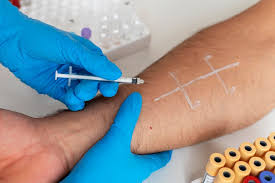 Image result for Allergy Screening