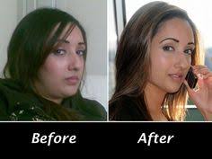 Thickened skin of lower legs with a pale or yellowish appearance. Hypothyroid Before And After Photos