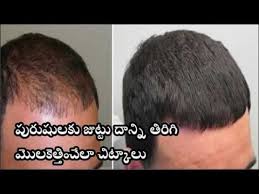 Hair Regrowth Tips For Men In Telugu Hair Loss Treatment Prp Hair Loss Treatment Hair Transplant Women