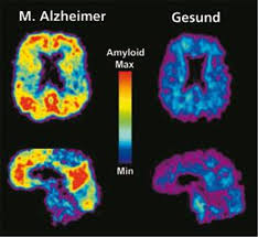 Umgang mit dem thema demenz. Alzheimer Lasst Sich Immer Fruher Erkennen