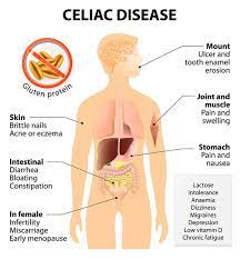 Classic symptoms include gastrointestinal problems such as chronic diarrhoea. Celiac Disease Symptoms List Of 281 Ailments University Health News
