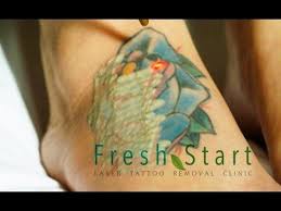 In most cases, laser tattoo removal austin considerably improves the appearance of skin. Tattoo Removal Before And After Photo Shown By Fresh Start Tattoo Removal Austin