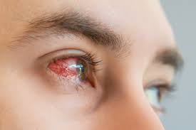 Rottura capillari occhio: quali sono le cause e quando è grave?