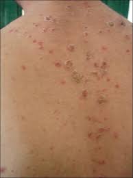 Maybe you would like to learn more about one of these? A Case Of Reiter S Disease Exacerbated By Lithium Abstract Europe Pmc
