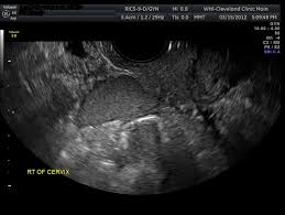 Early ovarian cancer rarely has symptoms. Ovarian Cysts