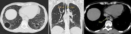 Scleroderma Associated Interstitial Lung Disease Radiology At St Vincent S University Hospital