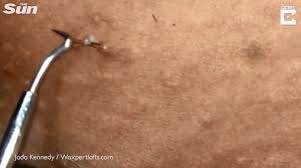 Above, infected armpit hair (right) and view of hair under a microscope (left). Grim Video Shows Pus Stream Out Of Woman S Bikini Line As Ingrown Hairs Are Pulled Out