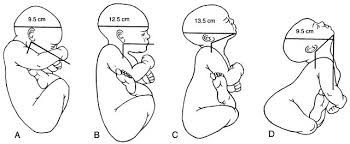 Image result for Brow Presentation