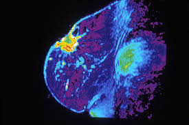 It's the most common cancer in women, although it can also develop in men. Test Determines Most Effective Treatment For Breast Cancer