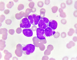 We did not find results for: Causas Agudas De La Leucemia Mieloide
