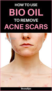 Acne Bio Oil Before After Pin On Bio Oil Diy