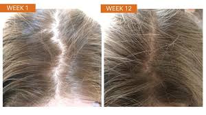 I know, i still have a long way to go but i feel i need. Hr23 Hair Supplement Before After Case Study 2