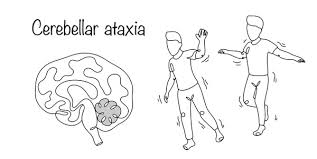 Image result for Ataxia