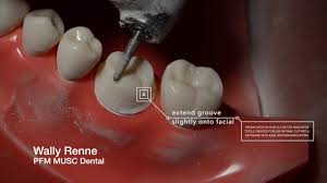 The pfm is subject to periodic revisions upon action by the board of supervisors. Pfm Crown Prep And Animation For Dental Students Youtube