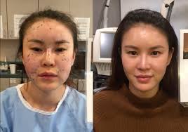 If you have a really long nose, for instance, and you want it to appear slim but smaller, you would put highlight on the tip of your nose, and contour the bridge and the tip with a darker shade to make the bridge look shorter. Patient Story 31 Year Old Female Patient 3 D Contour Of Face Following Fat Transfer John Kang Md F A C S Jk Facial Plastics Reconstructive