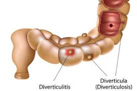 Voir la définition de péritonite dans le littré. Chirurgie Colorectale Qu Est Ce Que La Diverticulite
