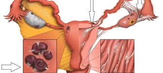 Program na temat endometriozy w tvp. Endometrioza Cz 3 Alternatywne Wspomaganie Leczenia Psychodietetyk I Specjalista Medycyny Funkcjonalnej