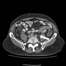 Find out what it is and how you have it. Oligometastatic Disease In Prostate Cancer Advances In Diagnosis And Treatment Intechopen