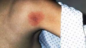 Borreliose Erkennen Tests Und Untersuchungen Zur Diagnose Onmeda De