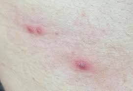 Zona zoster se manifesta prin durere si aparitia unei benzi eruptive cutanate, ea fiind determinata de acelasi virus care apare si la varicela. Care Este Conduita Si Tratamentul In Zona Zoster