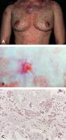 Image result for Merkel Cell Carcinoma