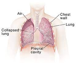 Since you run, i am assuming you do not smoke. Collapsed Lung Pneumothorax