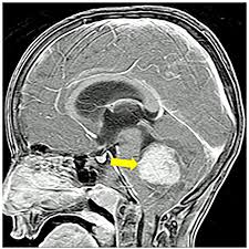 How do you get brain cancer? Cracking The Code Of A Brain Cancer That Keeps Coming Back Eurekalert Science News