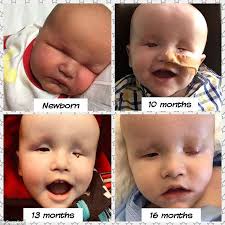 Baby boy born without eyes undergoes operation and is set to get a  prosthetic eye