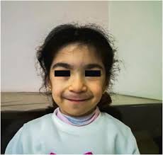 Hajdu Cheney syndrome; A novel NOTCH2 mutation in a Syrian child, and  treatment with zolidronic acid: A case report and a literature review of  treatments