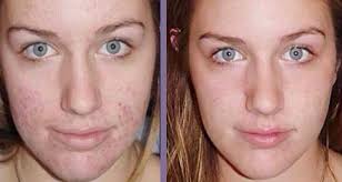 Comment Utiliser Du Vinaigre De Cidre Sur La Peau Peeling Visage Cicatrices Acne Peau Blanche
