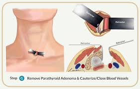 Parathyroidectomy Parathyroid Gland Removal Surgery Dr Larian