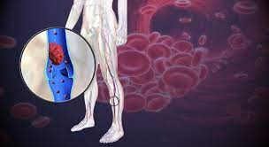 Symptoms Of Blood Clot In Leg Myheart