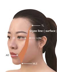 Buccal Fat Pad Augmentation for Midfacial Rejuvenation: Modified Fat  Grafting Technique and Ogee Line Remodeling