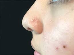 Image result for Pyogenic Granuloma