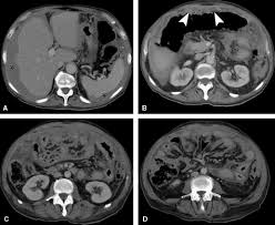 The main symptoms are swollen or painful abdomen, loss of appetite, loss of weight, and night sweats. Ct Imaging Of Peritoneal Carcinomatosis And Its Mimics Sciencedirect